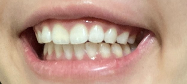 ホワイトニング後の歯
