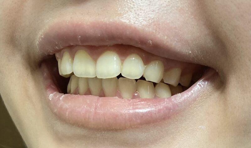 ホワイトニング前の歯
